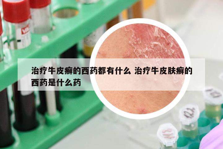 治疗牛皮癣的西药都有什么 治疗牛皮肤癣的西药是什么药