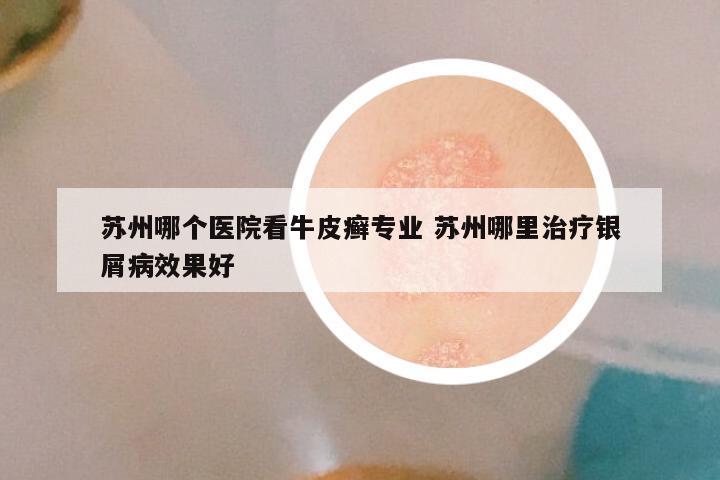 苏州哪个医院看牛皮癣专业 苏州哪里治疗银屑病效果好