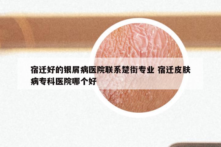 宿迁好的银屑病医院联系楚街专业 宿迁皮肤病专科医院哪个好