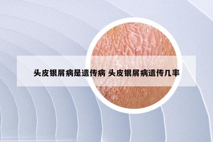 头皮银屑病是遗传病 头皮银屑病遗传几率