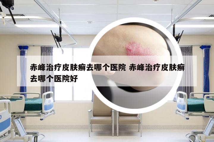 赤峰治疗皮肤癣去哪个医院 赤峰治疗皮肤癣去哪个医院好