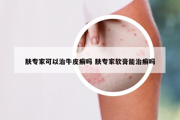 肤专家可以治牛皮癣吗 肤专家软膏能治癣吗