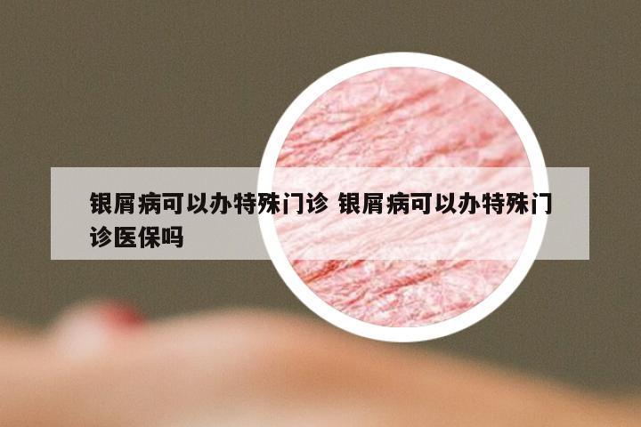 银屑病可以办特殊门诊 银屑病可以办特殊门诊医保吗
