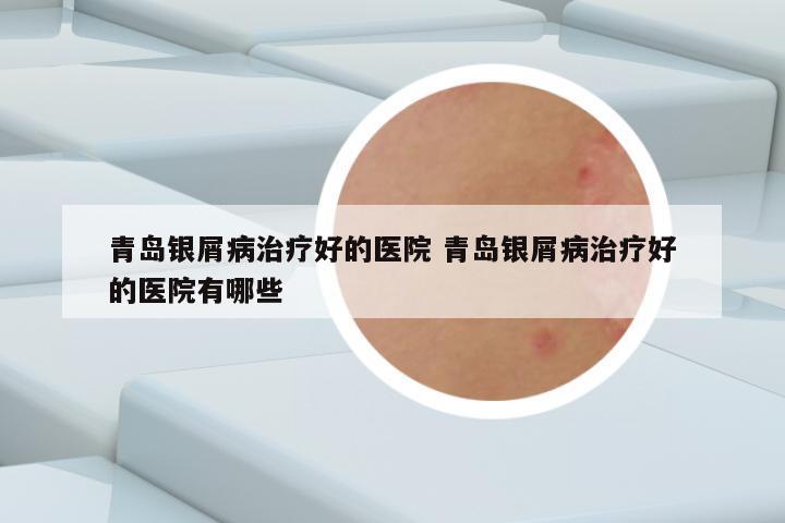 青岛银屑病治疗好的医院 青岛银屑病治疗好的医院有哪些