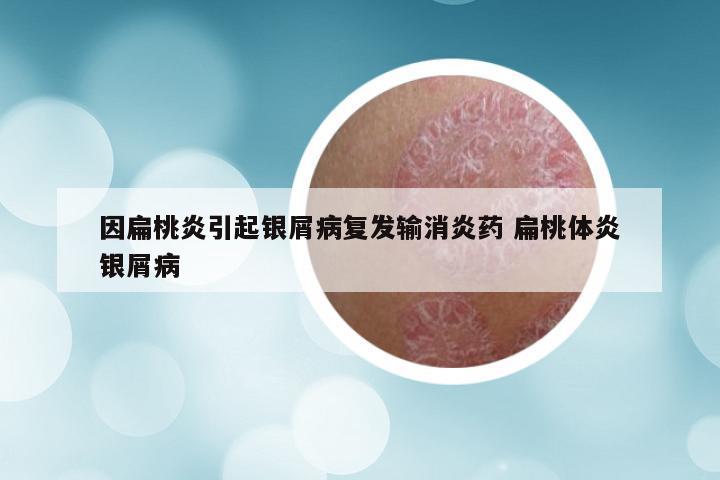 因扁桃炎引起银屑病复发输消炎药 扁桃体炎银屑病