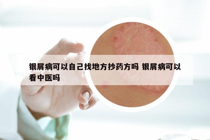 银屑病可以自己找地方抄药方吗 银屑病可以看中医吗
