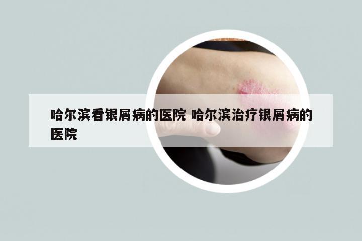 哈尔滨看银屑病的医院 哈尔滨治疗银屑病的医院