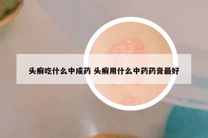 头癣吃什么中成药 头癣用什么中药药膏最好