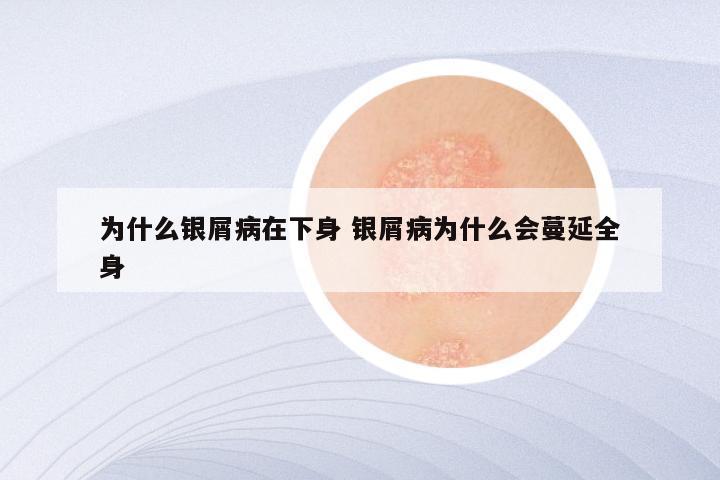 为什么银屑病在下身 银屑病为什么会蔓延全身