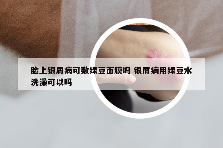 脸上银屑病可敷绿豆面膜吗 银屑病用绿豆水洗澡可以吗