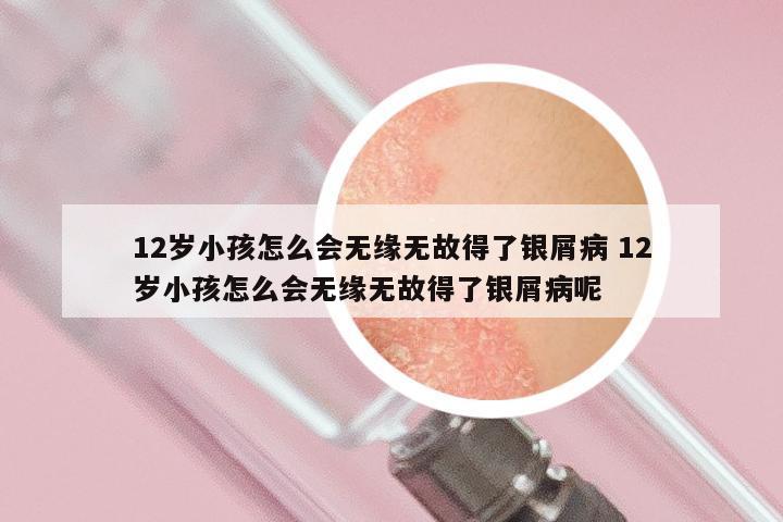 12岁小孩怎么会无缘无故得了银屑病 12岁小孩怎么会无缘无故得了银屑病呢