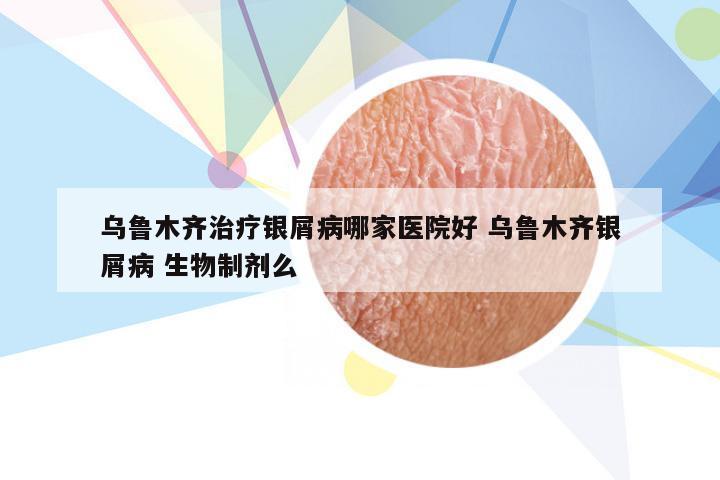 乌鲁木齐治疗银屑病哪家医院好 乌鲁木齐银屑病 生物制剂么