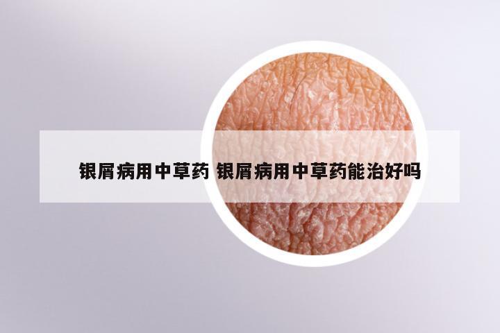 银屑病用中草药 银屑病用中草药能治好吗
