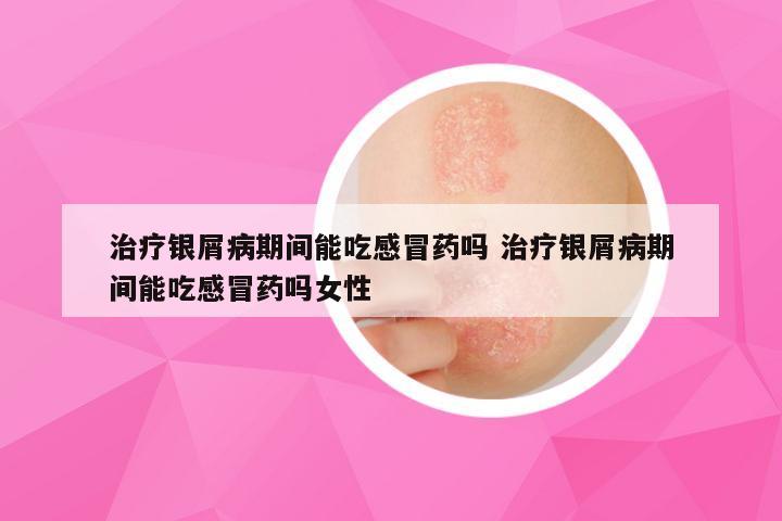 治疗银屑病期间能吃感冒药吗 治疗银屑病期间能吃感冒药吗女性