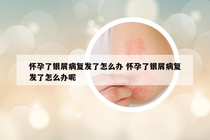 怀孕了银屑病复发了怎么办 怀孕了银屑病复发了怎么办呢