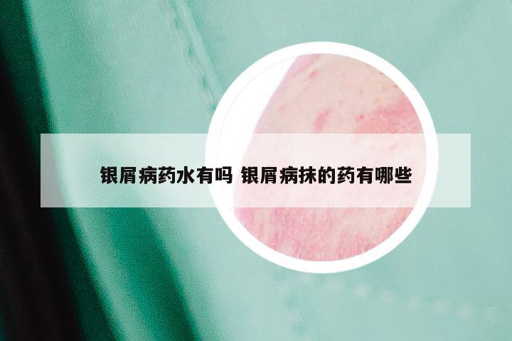 银屑病药水有吗 银屑病抹的药有哪些