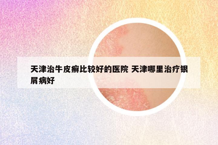 天津治牛皮癣比较好的医院 天津哪里治疗银屑病好