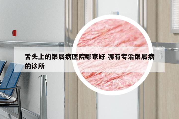 舌头上的银屑病医院哪家好 哪有专治银屑病的诊所
