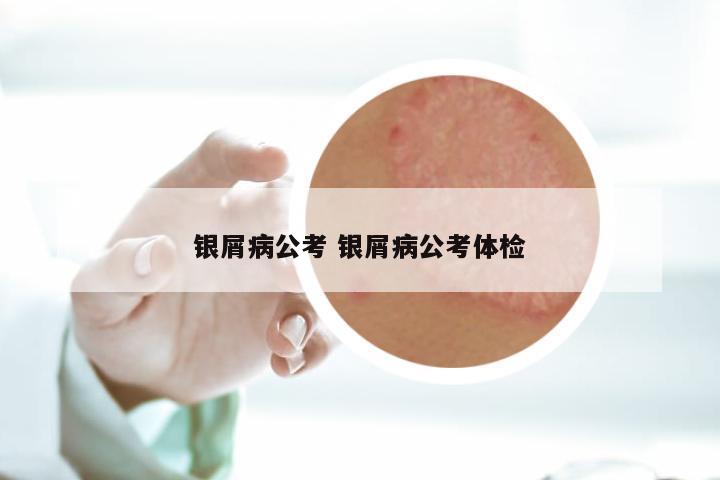银屑病公考 银屑病公考体检