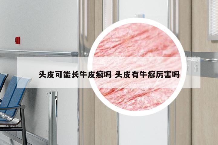 头皮可能长牛皮癣吗 头皮有牛癣厉害吗
