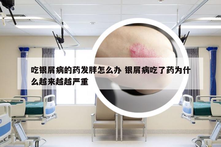 吃银屑病的药发胖怎么办 银屑病吃了药为什么越来越越严重