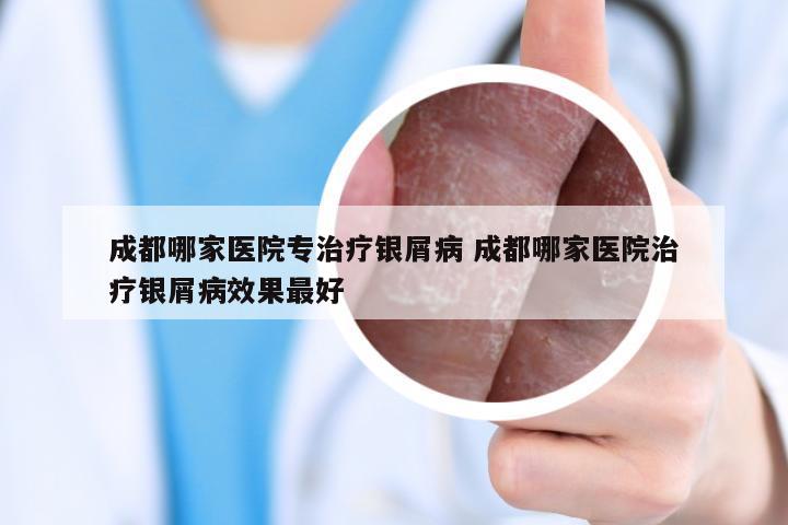 成都哪家医院专治疗银屑病 成都哪家医院治疗银屑病效果最好
