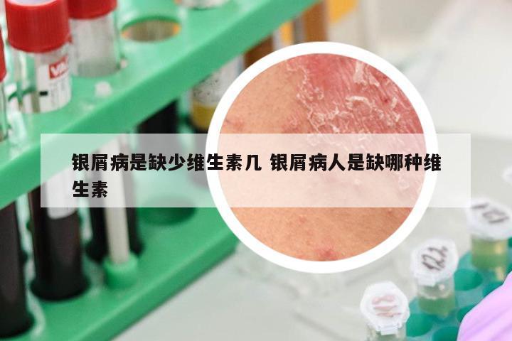 银屑病是缺少维生素几 银屑病人是缺哪种维生素
