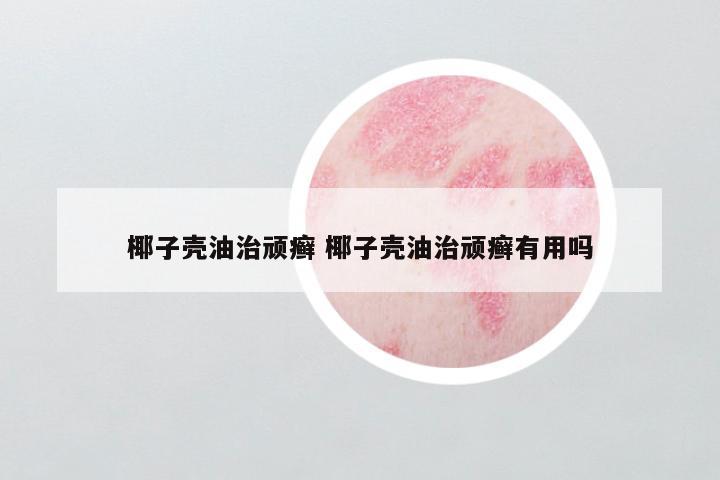椰子壳油治顽癣 椰子壳油治顽癣有用吗