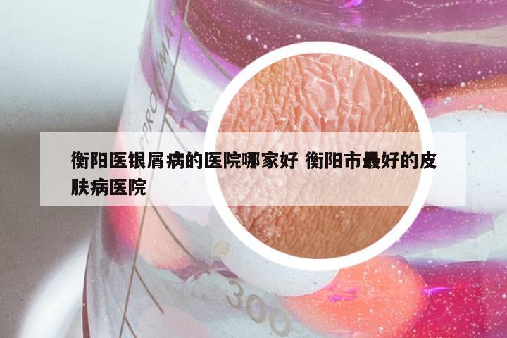 衡阳医银屑病的医院哪家好 衡阳市最好的皮肤病医院