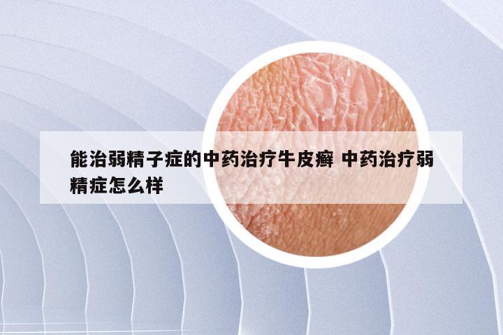 能治弱精子症的中药治疗牛皮癣 中药治疗弱精症怎么样