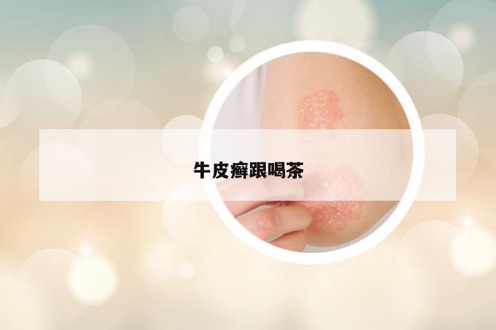 牛皮癣跟喝茶