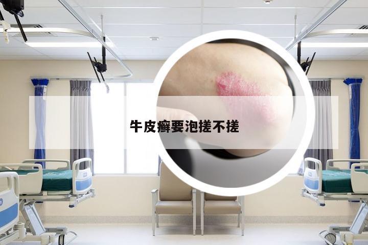 牛皮癣要泡搓不搓