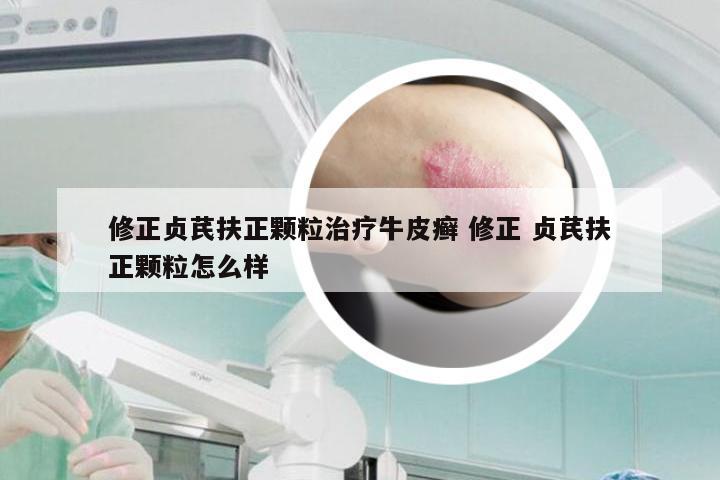 修正贞芪扶正颗粒治疗牛皮癣 修正 贞芪扶正颗粒怎么样