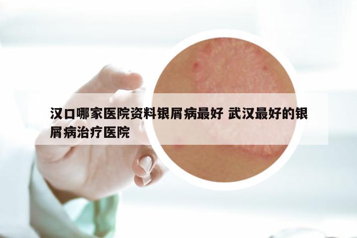 汉口哪家医院资料银屑病最好 武汉最好的银屑病治疗医院