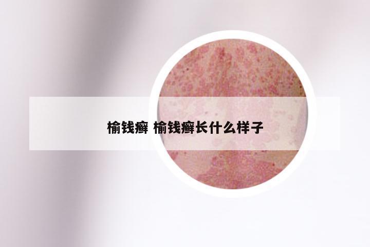榆钱癣 榆钱癣长什么样子