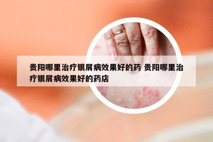 贵阳哪里治疗银屑病效果好的药 贵阳哪里治疗银屑病效果好的药店