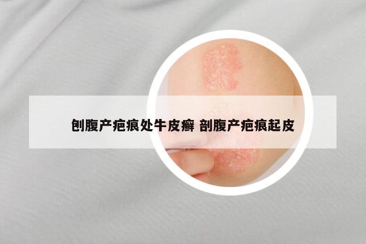 刨腹产疤痕处牛皮癣 剖腹产疤痕起皮