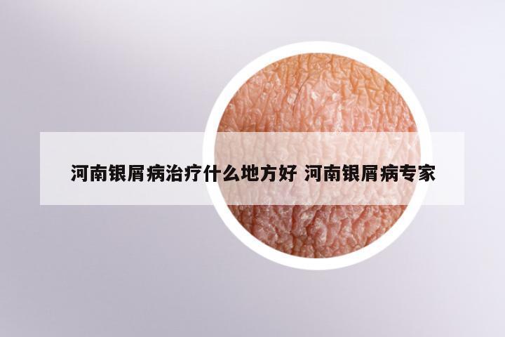 河南银屑病治疗什么地方好 河南银屑病专家