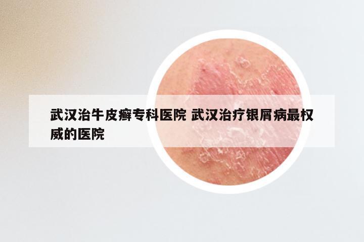 武汉治牛皮癣专科医院 武汉治疗银屑病最权威的医院