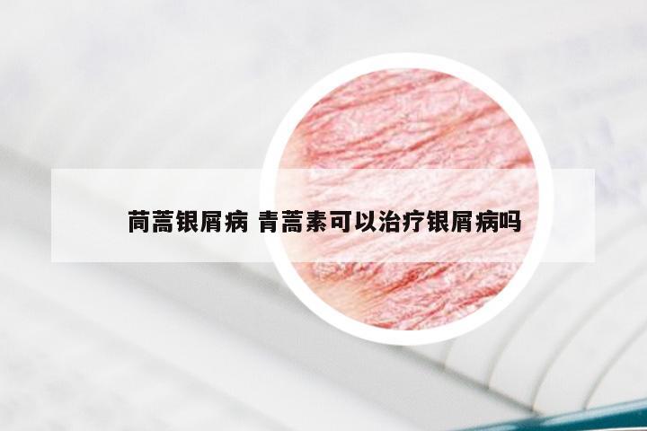 茼蒿银屑病 青蒿素可以治疗银屑病吗