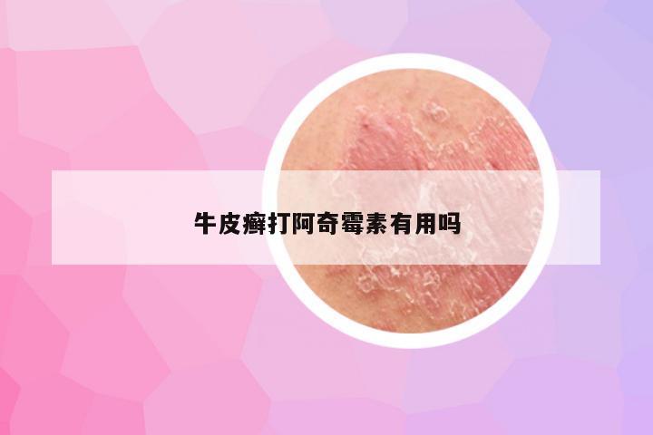 牛皮癣打阿奇霉素有用吗