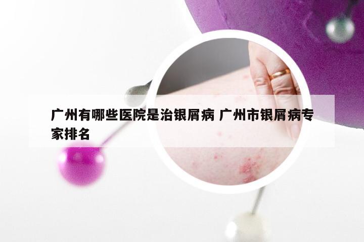 广州有哪些医院是治银屑病 广州市银屑病专家排名