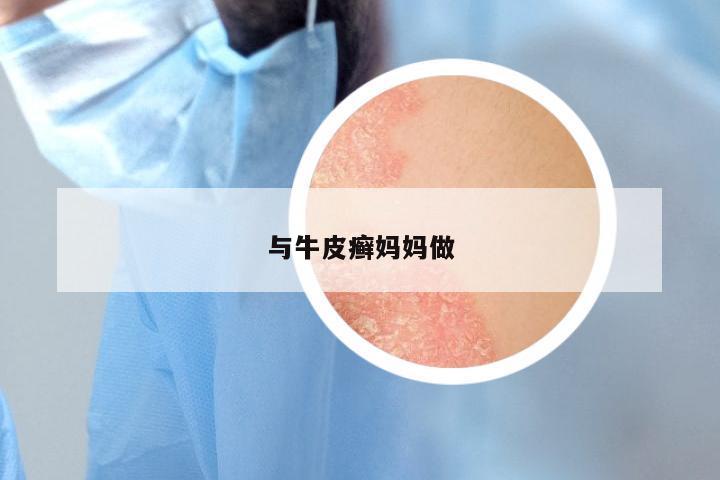 与牛皮癣妈妈做