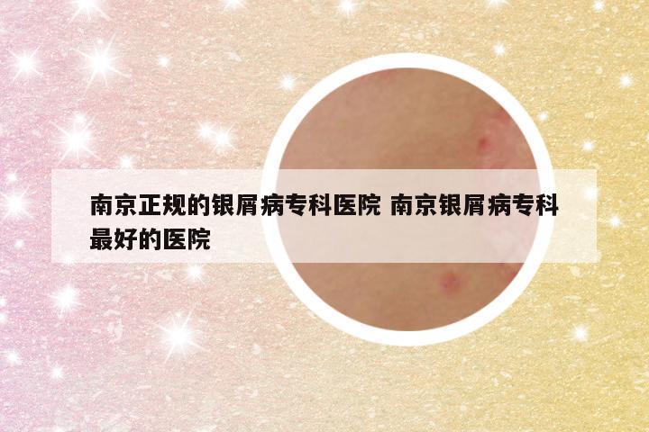 南京正规的银屑病专科医院 南京银屑病专科最好的医院
