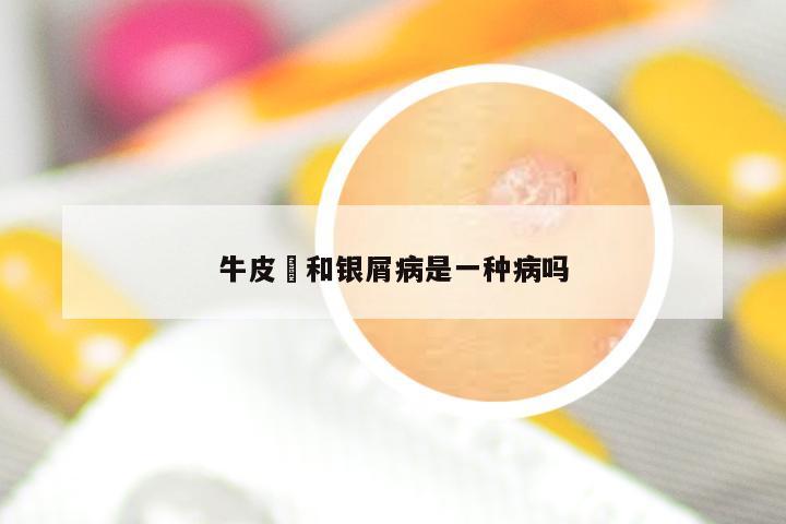 牛皮癬和银屑病是一种病吗