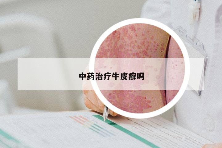 中药治疗牛皮癣吗