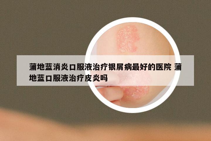 蒲地蓝消炎口服液治疗银屑病最好的医院 蒲地蓝口服液治疗皮炎吗