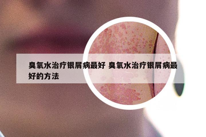 臭氧水治疗银屑病最好 臭氧水治疗银屑病最好的方法