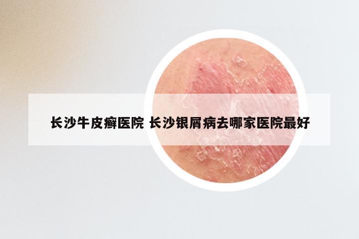 长沙牛皮癣医院 长沙银屑病去哪家医院最好