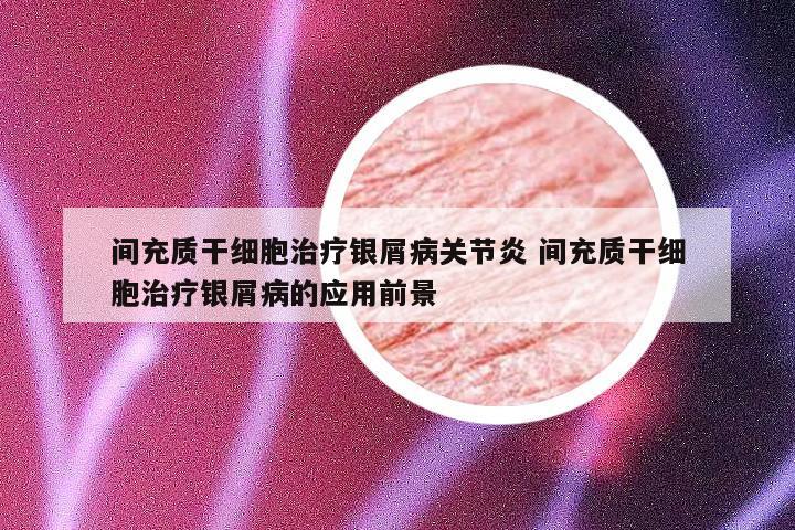间充质干细胞治疗银屑病关节炎 间充质干细胞治疗银屑病的应用前景